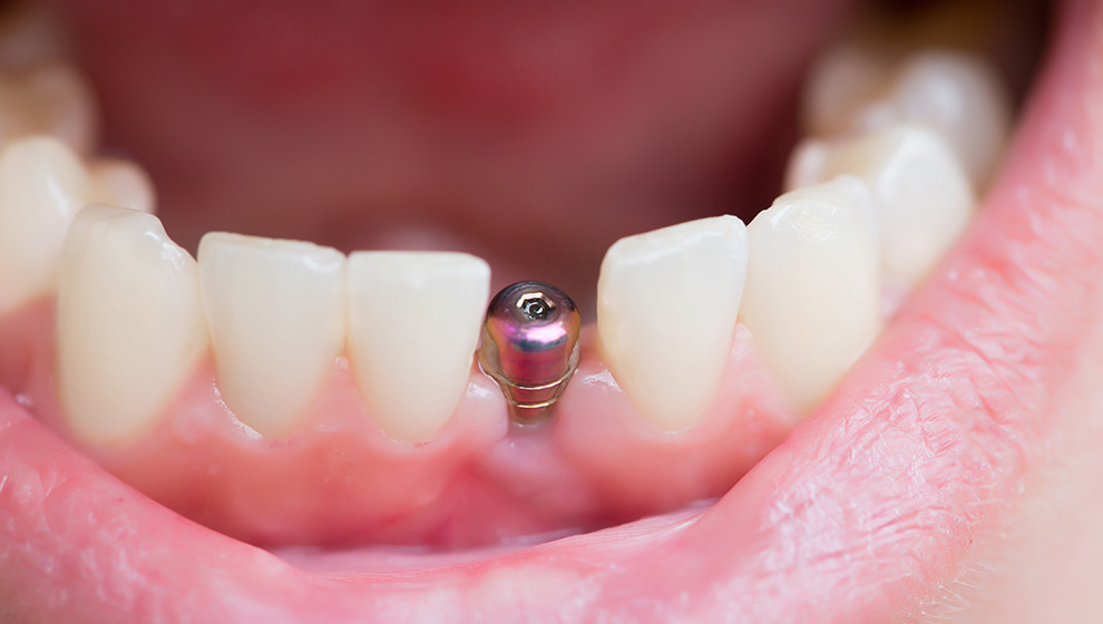 Implantat vom Zahnarzt in Nümbrecht
